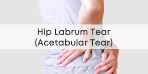 Hip (Acetabular) Labrum Tear | PhysioRoom Injury Advice