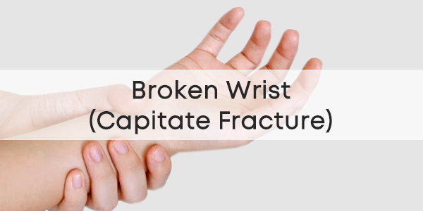 Broken Wrist (Capitate Fracture)