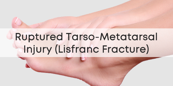 Ruptured-Tarso-Metatarsal-Injury-Lisfranc-Fracture